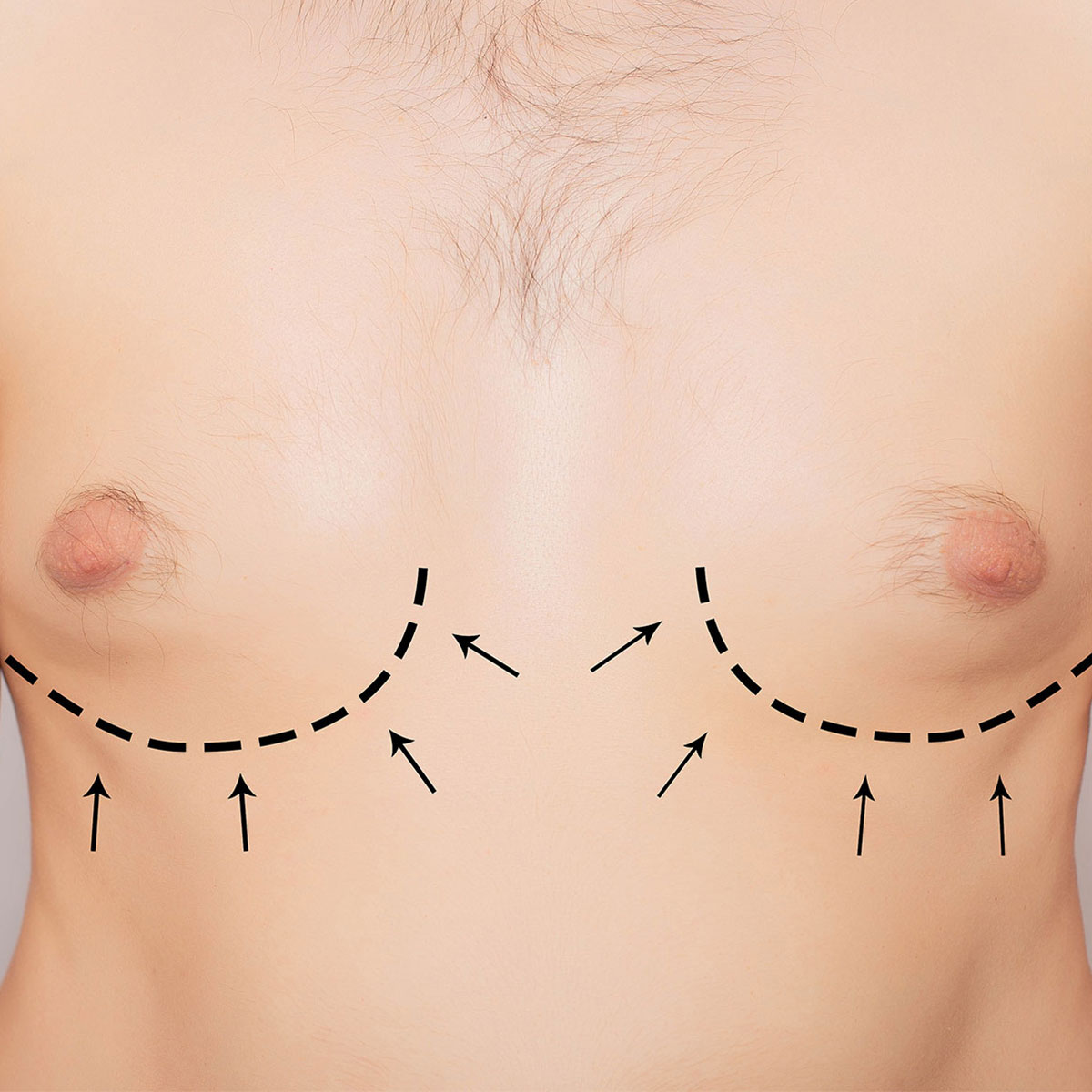 Dr. med. Π. Καραϊσκάκης | Πλαστικός Χειρουργός | Θεραπείες Στήθους | Γυναικομαστία